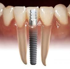 Tooth Implant Cost