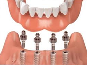 Implant Dentures