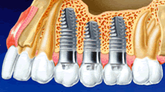 Dental Implants Cost