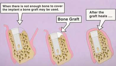 bone grafting