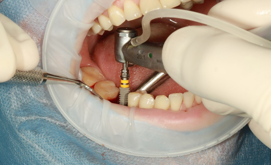 Factors To Consider Before Getting Dental Implants