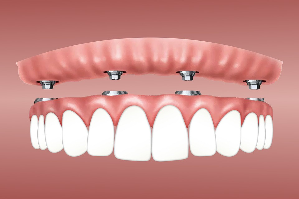 cheapest dental implants in Sydney