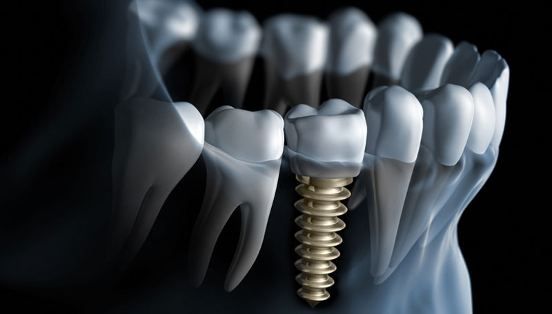 How does Dental Implant work with existing natural Teeth?