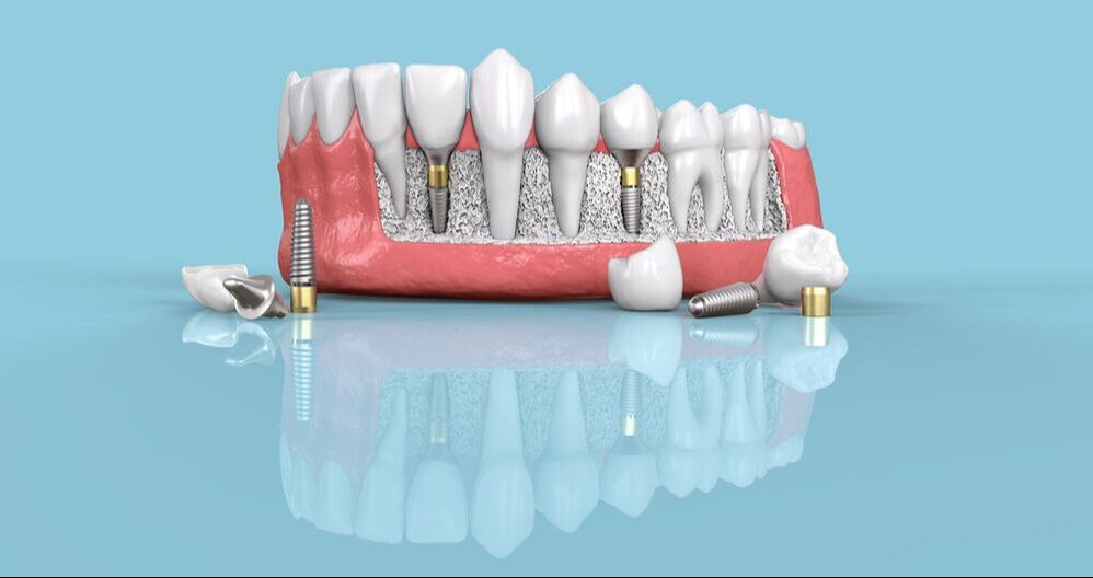 All on Four Implants Procedure 101