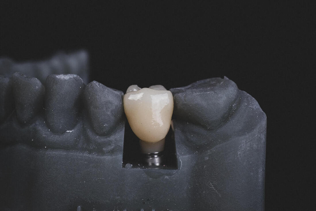 Do’s and Don’ts after Dental Implants Procedure