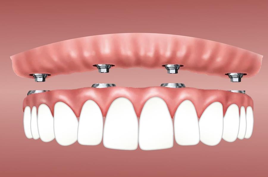 Dental Implants cost in Sydney
