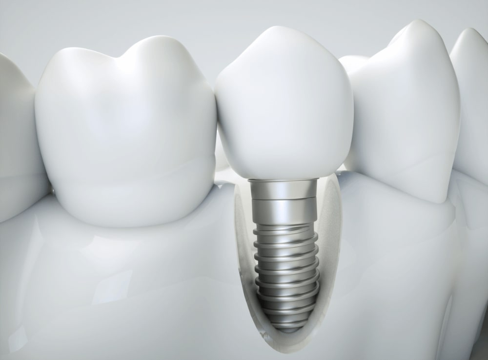 Common Signs Indicating the Need for Dental Implants