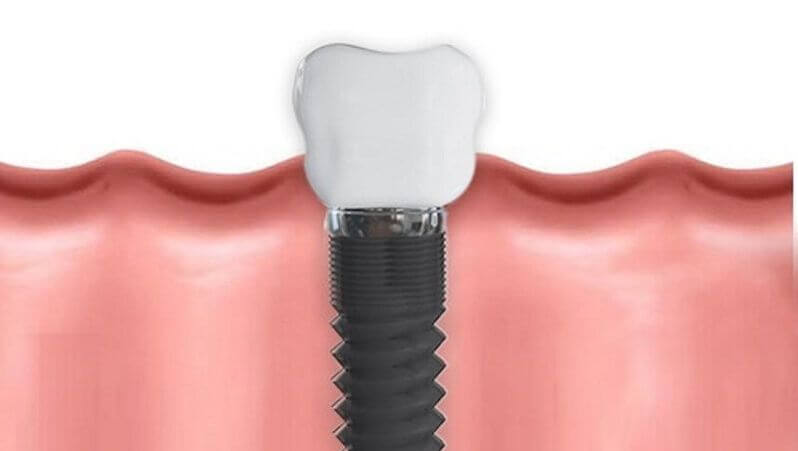 Dental Implants Procedure