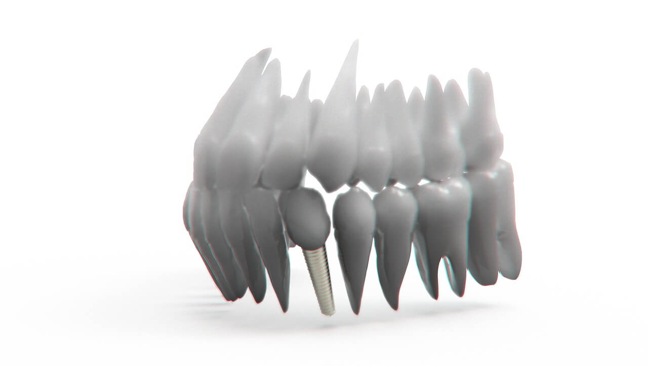 All On 4 Dental Implants - A Perfect alternative to Dentures