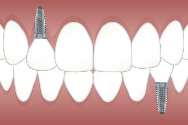 Misconceptions about Tooth Implants