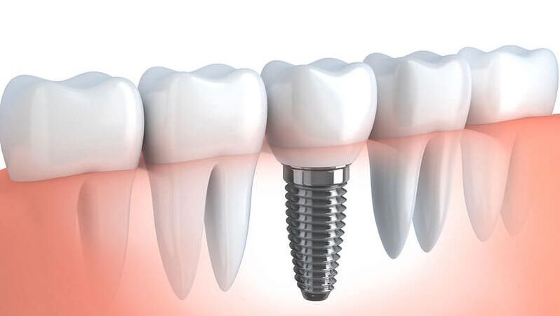 Is it worth it to Invest in Dental Implants?