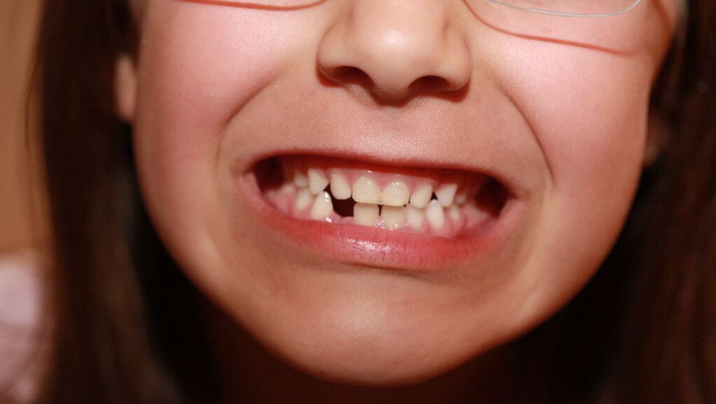 Good Reasons to Replace Missing Teeth with Dental Implants