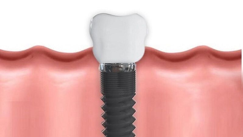Everything You Need to Know About All-On-4 Dental Implants 